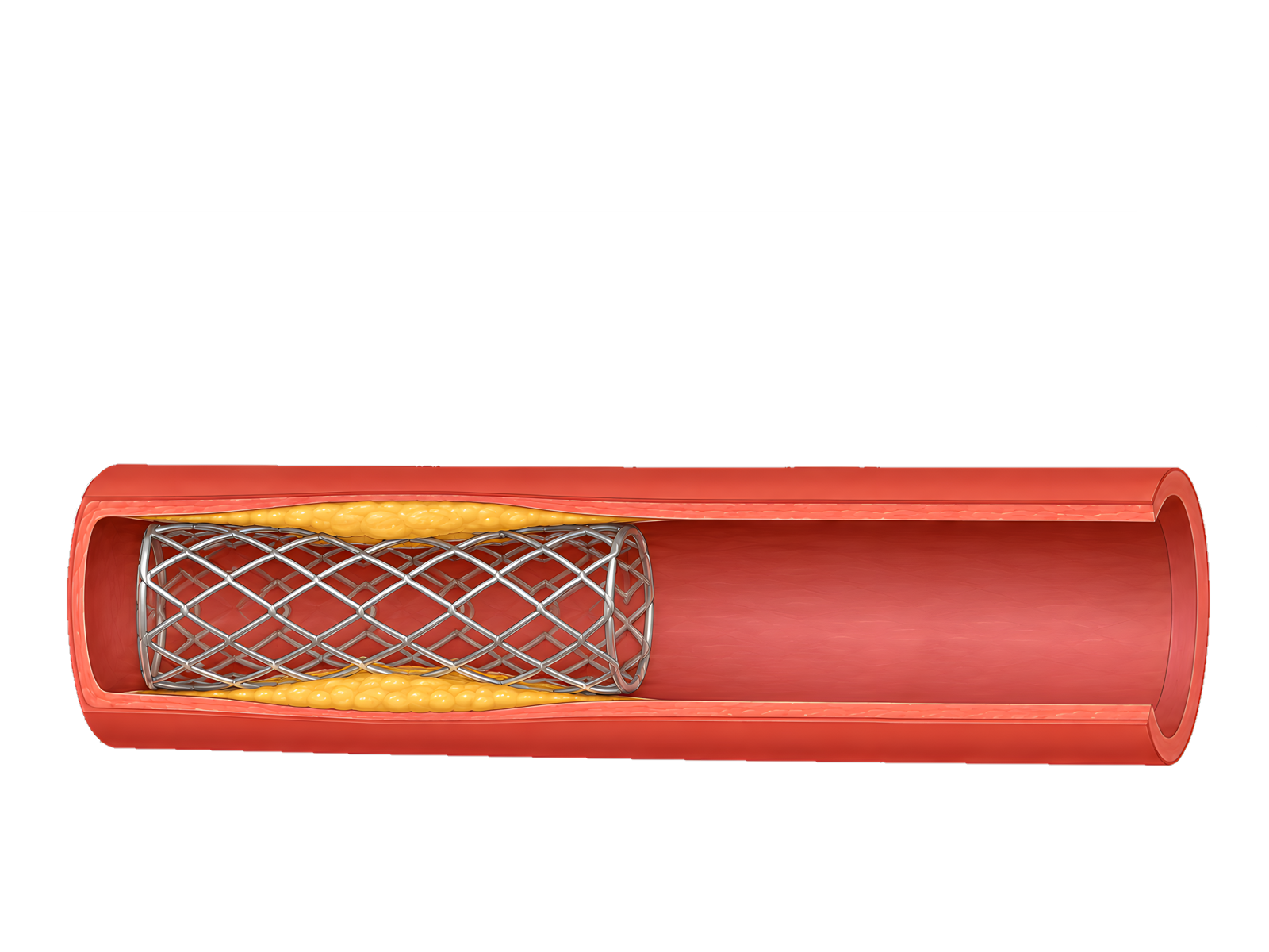 PCI stent