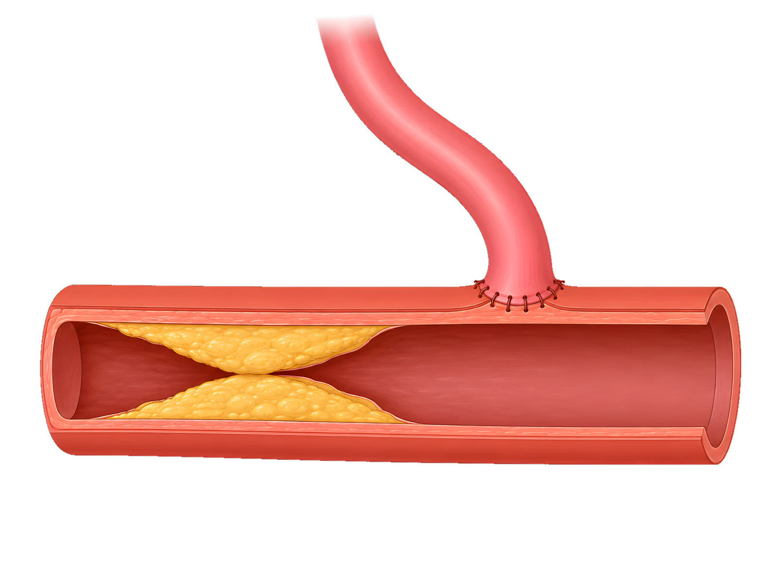 CABG bypass