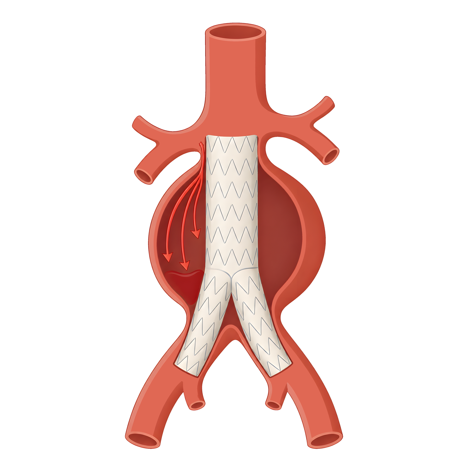 第一型內漏（Type I Endoleak）：近端錨定區密封不良