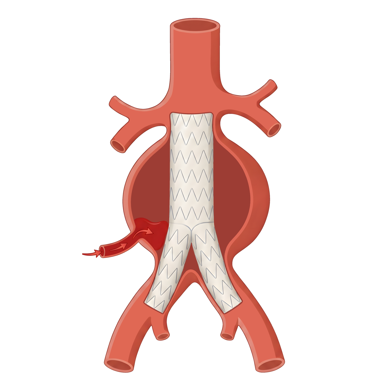 第二型內漏（Type II Endoleak）：側枝腰動脈逆流